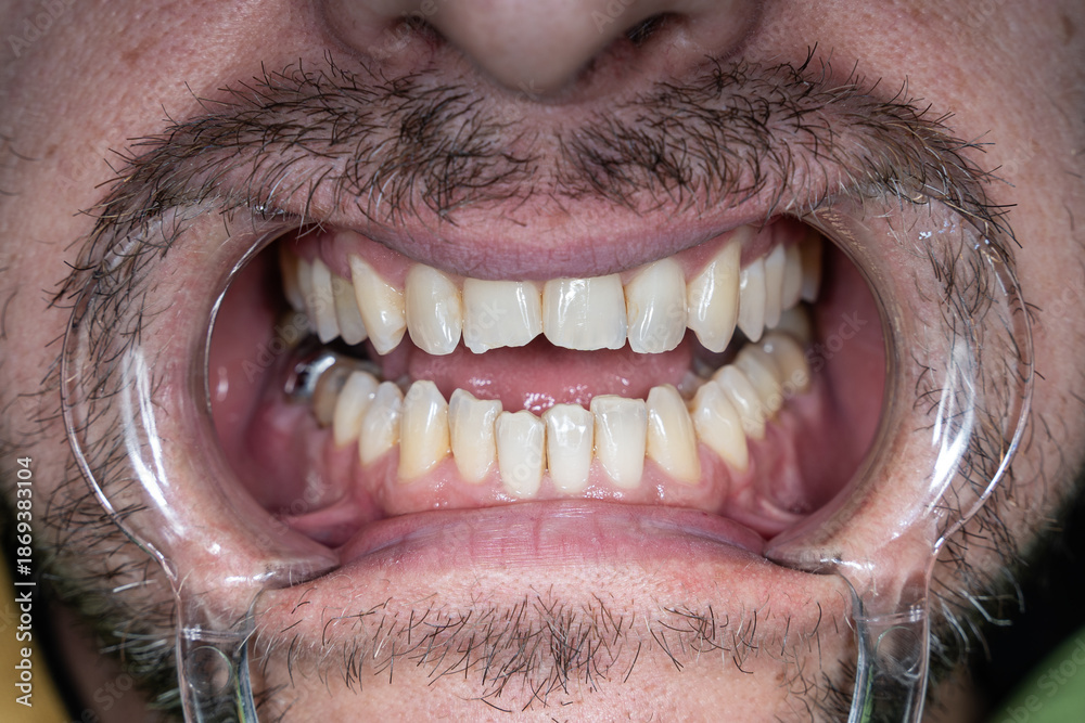 Teeth of a man. The mouth is wide open with retractors, the teeth are ...