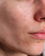 © rinrada - Macro image of acne-prone facial skin with visible pores on white background