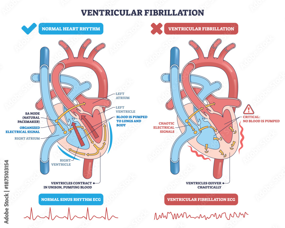 Ventricular Fibrillation Explained Side by side Heart Diagram Ventricular Fibrillation Explained Side by side Heart Diagram