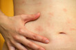 © leroy - Atopic dermatitis on the abdominal skin of a woman, severe itching on the side. Allergy or urticaria, hives.