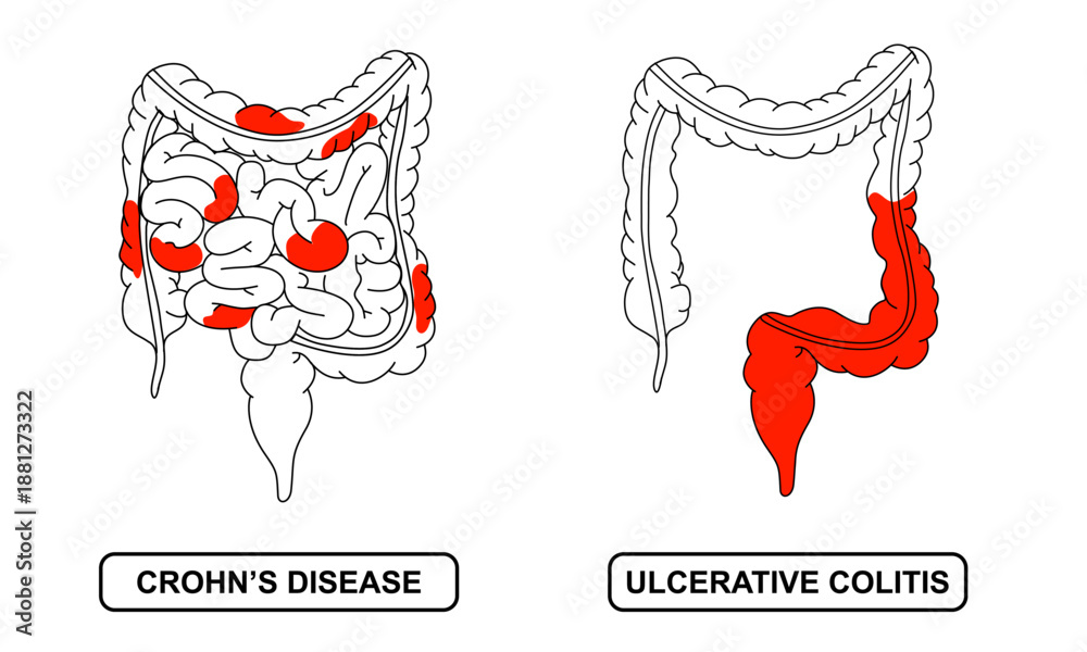 Ulcerative Colitis Digram Illustration of Crohn's disease and ulcerative colitis. inflammatory ...