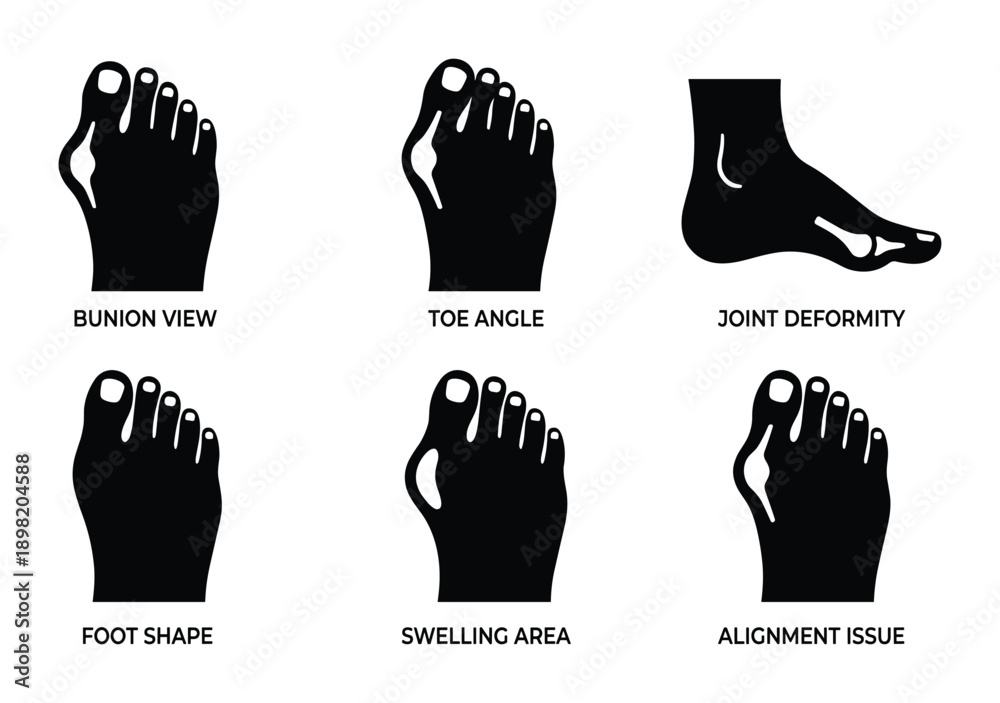Foot Deformities Diagram Bunion Toe Angle Joint Foot Shape Swelling ...