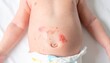 © midnight pixel - Close-up view of an infant's belly with a severe skin rash or burn, showing inflamed and blistered areas around the navel, highlighting common pediatric dermatological concerns