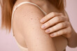 © Pixel-Shot - Young woman with moles on pink background, closeup