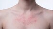 © W.O.W - Caucasian man’s chest with red skin rash. Allergic reaction, eczema, or contact dermatitis problem on body for health care concept.