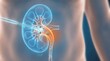 © WisChi - Medical illustration depicting lithotripsy breaking up kidney stones within a human kidney