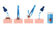© DHS - Illustration of tick removal steps: 1. Apply liquid on tick using dropper. 2. Use tweezers to grasp tick. 3. Lift tick upward. 4. Apply liquid to wound. 5. Place tick in container.