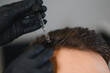 © Serhii - Hair treatment serum applying to scalp restoring hair growth