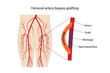 © Olga - Femoral artery bypass grafting. Medical illustration of the lower extremities and femoral artery bypass grafting diagram. Vector flat style illustration on a white background.