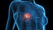 © Sebastian Kaulitzki - Comprehensive Anatomical Render Of Breast Cancer In A Human Female