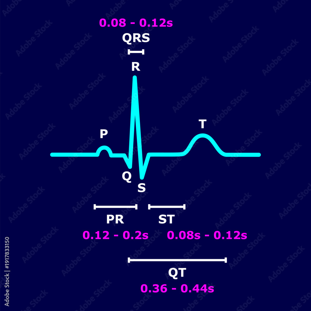 Normal ECG sinus rhythm with labeled P wave, QRS complex, T wave, PR ...