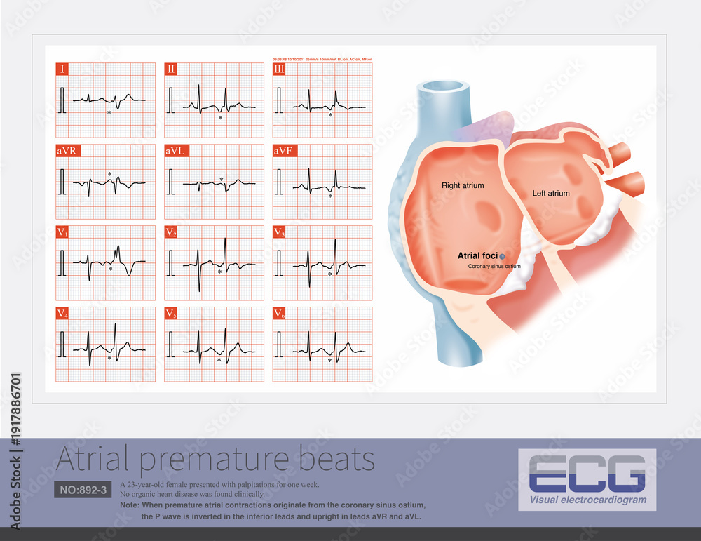 When premature atrial contractions originate from the coronary sinus ...