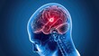 © feng - Medical illustration and diagnostic visualization of brain tumor, abnormal tissue growth in the human brain affecting neurological function. Concept for neurosurgery, oncology, brain cancer diagnosis