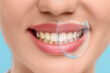 © New Africa - Woman smiling on light blue background, closeup. Dental care, protection after teeth whitening