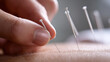 © AnastasiiaAkh - Acupuncture needles inserted into human skin during alternative therapy treatment, close-up medical wellness concept