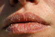 © Aamir - Close-up of lips showing dryness, cracking, and clustered fluid-filled blisters on lower lip, characteristic of herpes simplex virus outbreak. Medical representation highlights cold sore symptoms.