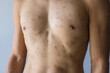 © leungchopan - Human male torso with visible skin disease