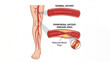 © AiDesign - Normal Artery versus Peripheral Artery Disease PAD reduced blood flow medical education infographic showing leg artery blockage plaque buildup and vascular circulation comparison