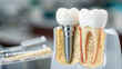 © mh - Close up view of dental implant anatomy for treatment