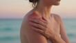 © mihrzn - A woman with a visibly sunburned shoulder, hand gently touching the irritated area, set against a soft-focus beach backdrop under warm sunlight.