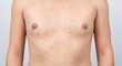 © mdmojibur - A close up view of a person torso showing a widespread skin rash with many small red spots or bumps
