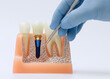 © Maximusdn - Gloved hand using dental explorer on a cross-sectional implant model showing jawbone integration and surrounding natural teeth for training.