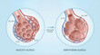 © Medical Comparisons - Healthy Alveoli vs Emphysema: Lung Structure and Oxygen Exchange Comparison
