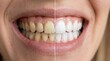 © akridiy - Teeth whitening comparison before and after cosmetic dental procedure