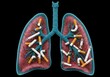 © Rainyphoto - Conceptual graphic showing the pulmonary contour heavily littered with cigarette waste. Illustrates serious respiratory damage and toxic contamination, illustration, toxic, visualization