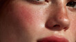 © Valena - Closeup of human face with redness rosacea and irritated skin texture showing sensitive dermatology condition and healthcare concept