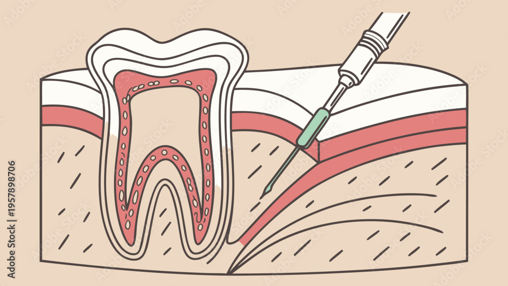 Tooth Root Injection Dental anatomy diagram showing tooth layers and anesthetic injection ...