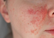 © Alina - Close-up of a young womans face with visible skin irritation and redness. Inflamed, dry, and textured skin. Concept of sensitive skin, allergy, inflammation, and skincare problems