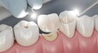 © Alisa - Dental Crown Placement Procedure - Close Up of Tooth Restoration