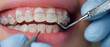 © Tatsiana - Dentist performing orthodontic treatment with braces while ensuring patient comfort during brightening process