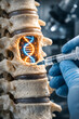 © Jørgsson Photography - Futuristic medical procedure showing spinal injection with glowing DNA helix inside vertebrae, symbolizing advanced genetic therapy, biotechnology innovation and precision medicine.