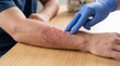 © Jayk - Medical professional examines a severe burn wound on a patient's forearm with gloved hands