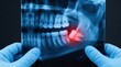 © Jayk - Dentist holding dental x-ray showing impacted wisdom tooth with red pain indicator