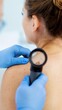 © olgakris - Dermatologist examining suspicious skin mole on woman shoulder with dermatoscope during dermatology screening, early melanoma detection, skin cancer prevention, teledermatology monitoring clinical