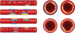 © Sanjida - Artery Blockage Progression Illustration with Cholesterol Plaque Buildup and Blood Flow Restriction Cross Section Cardiovascular Disease Medical Vector Diagram Set