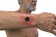 © Dr_Microbe - Cutaneous anthrax lesion on the forearm. Exhibits a characteristic painless black necrotic eschar with an extensive peripheral erythematous ring and tissue edema, generative ai illustration.