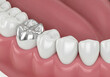 © Jignesh - Close-up view of dental teeth with a silver filling on one tooth