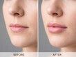 © Bilal - A woman's lips before and after lip filler treatment