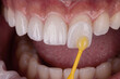 © Menuka - Close-up of a porcelain dental veneer being applied to a tooth with a dental tool for a cosmetic dentistry smile makeover