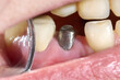 © elenavolf - Dentist using mirror to inspect dental implant abutment inside mouth demonstrating oral care and clinical examination
