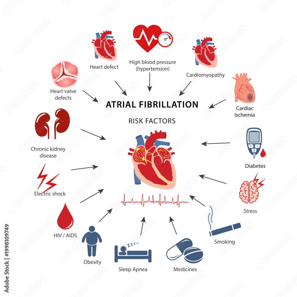 Diagram of risk factors for atrial fibrillation in humans. Flat style ...