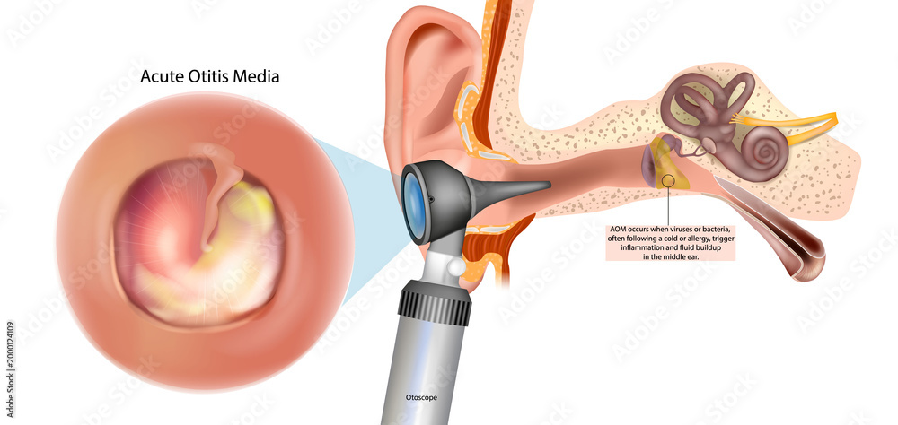 Acute Otitis Media Medical Illustration with Otoscope Ear Examination ...