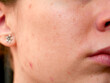 © Isabella - close up of a caucasian young woman's skin showing pores and blemishes