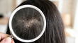 © RayenAI Studio - A detailed magnified view of a person's dark hair and scalp, revealing an excessive amount of white flakes, clearly indicating a common dandruff condition and poor scalp health