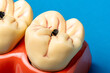 © AlvaroRT - Tooth model showing dental cavity and tooth decay