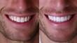 © liliyabatyrova - A close-up view showcases two smiles side by side, revealing the stunning difference in teeth brightness